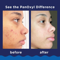 PanOxyl Acne Foaming Wash, 10% Benzoyl Peroxide, 5.5 oz, Pack of 2