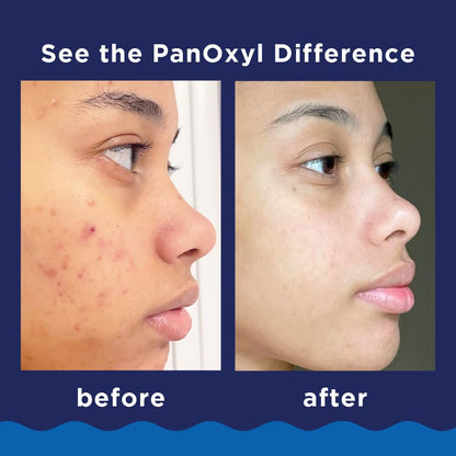 PanOxyl Acne Foaming Wash, 10% Benzoyl Peroxide, 5.5 oz, Pack of 2