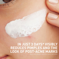 CeraVe Clay to Foam Acne Face Wash, Salicylic Acid Spot Treatment, 4 Oz